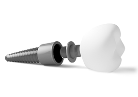 Illustration of dental implant lying on side