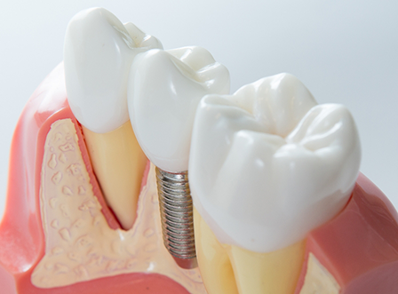 Model of dental implant in Austin