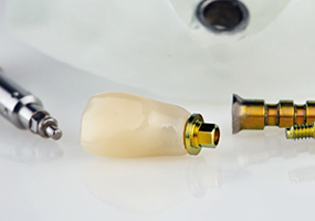 Close up of dental crown intended for dental implant