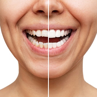 Nose-to-chin before/after shot of a flawed smile treated with veneers